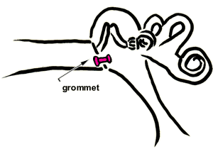 Grommet Insertion Ear